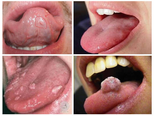Bệnh sùi mào gà ở miệng là do virus HPV gây nên