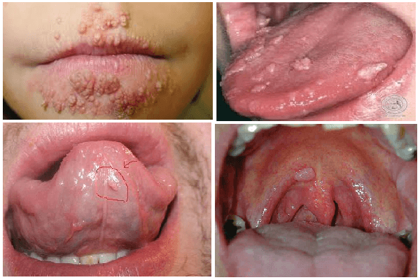 Sùi mào gà ở miệng hình thành là do virus Human Papilloma (HSV) gây nên