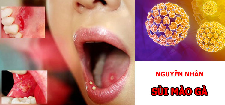 Nguyên nhân chủ yêu của bệnh sùi mào gà trong miệng là do quan hệ tình dục trong miệng