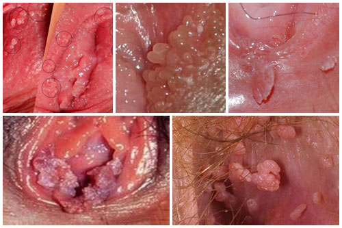 Sùi mào gà âm hộ do virus HPV gây ra