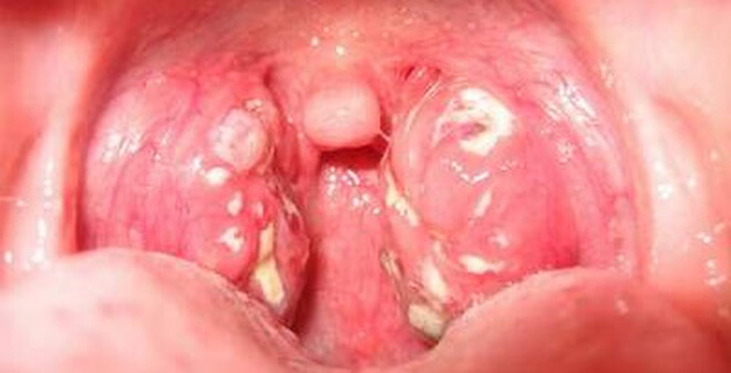Sùi mào gà ở miệng có thể dẫn đến bệnh ung thư vòm họng