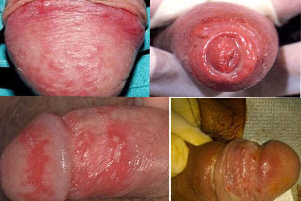 Bệnh mồng gà gây ra viêm quy đầu ở nam giới