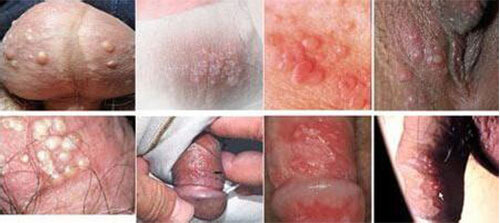 Bệnh mồng gà  ở nam giới là do virus HPV gây ra