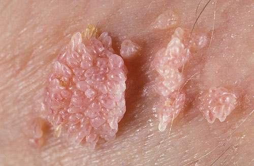 Xuất hiện các u nhú màu hồng tươi, mềm và có chân hoặc có cuống