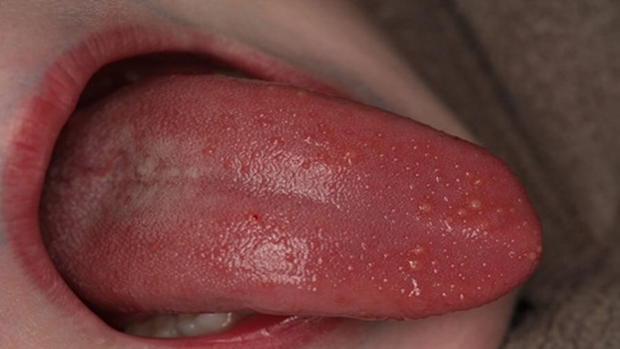 Biểu hiện sùi mào gà ở lưỡi thường là xuất hiện những nốt nhỏ li ti