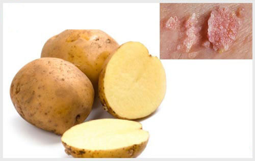 Sử dụng khoai tây để điều trị sùi mào gà tại nhà