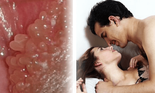 Quan hệ tình dục bằng miệng là nguyên nhân gây sùi mào gà ở họng