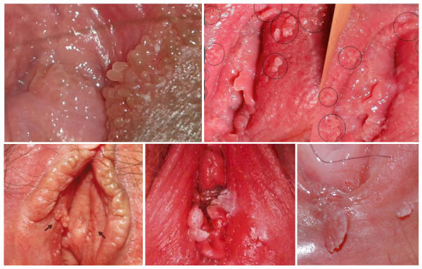 Sùi mào gà ở âm vật là hiện tượng virus HPV phát triển và gây u nhú tại âm vật của chị em