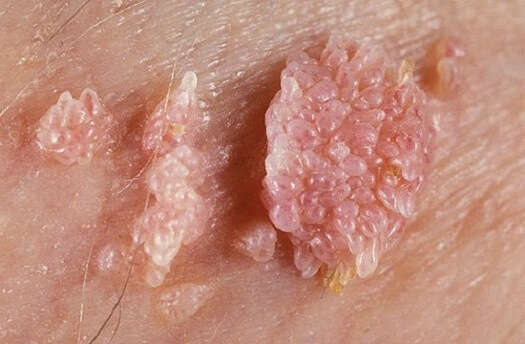 Sùi mào gà bắt nguồn từ virus HPV gây ra, thường xuất hiện ở cơ quan sinh dục, miệng, môi, nách