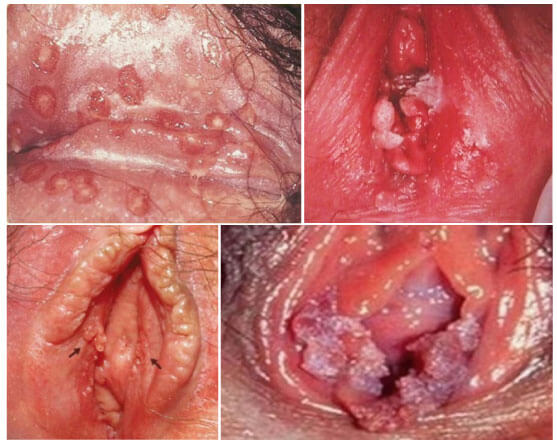 Sùi mào gà ở nữ được biết đến là một căn bệnh xã hội do virus HPV gây nên