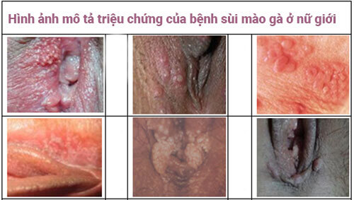 Sùi mào gà ở nữ là một căn bệnh nguy hiểm lây truyền qua đường tình dục, do hơn 20 chủng virus HPV gây ra