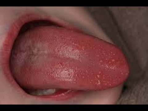 Triệu chứng sùi mào gà ở lưỡi thường là xuất hiện những nốt li ti