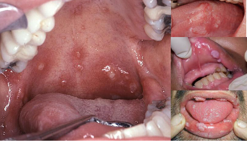 Triệu chứng sùi mào gà ở miệng hình thành do virus HPV xâm nhập và phát triển tại vùng miệng