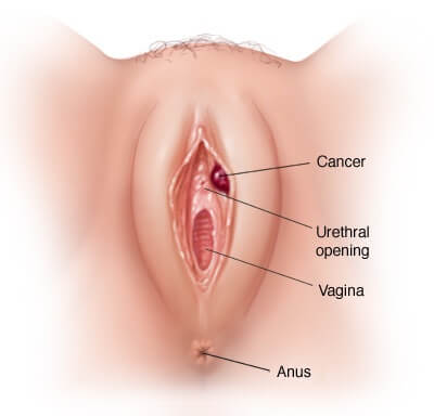 Ung thư âm đạo là tác hại nguy hiểm của bệnh sùi mào gà ở nữ