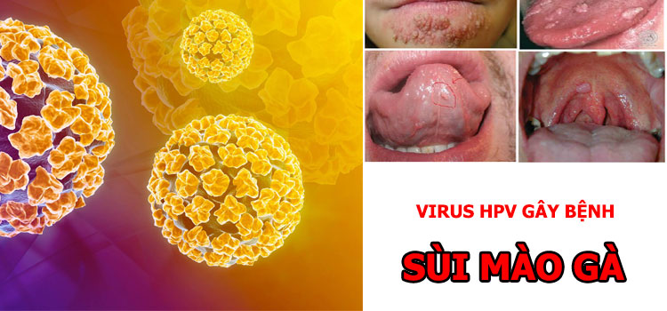 Virus hpv là nguyên nhân gây bệnh sùi mào gà ở miệng